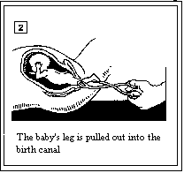 Partial Birth Abortion_2.gif (2005 bytes)