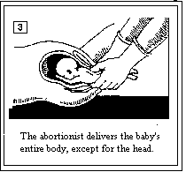 Partial Birth Abortion_3.gif (2342 bytes)